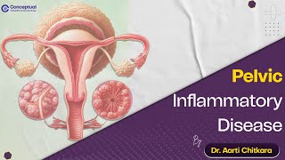 Pelvic Inflammatory Disease by Dr Aarti Chitkara  Conceptual OBG  OBS  GYN Residency [upl. by Akyeluz]