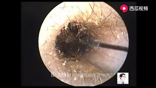 Treatment of rigid external auditory canal enucleation [upl. by Ahseek344]