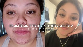 Bariatric surgery cleared my hormonal acne [upl. by Kashden]