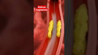 Balloon Angioplastyopening up Blockages with angioplasty [upl. by Htebasil]