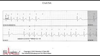 ECG Interpretation Tutorial  ChalkTalk 86  Intermediate Level [upl. by Massiw]