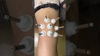 E105 Moxibustion therapy😃😄 for knee joint pain [upl. by Odlanor]