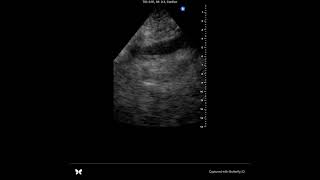 POCUS tamponade case [upl. by Dellora]