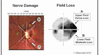 Glaucoma 1 Diagnosis [upl. by Ikkin]