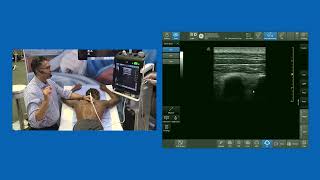 MTP Midpoint between Transverse process amp Pleura Block  aka InterTransverse Plane ITP Block [upl. by Agostino]