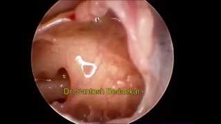 Endoscopic view of middle ear in perforated tympanic membrane [upl. by Howe]