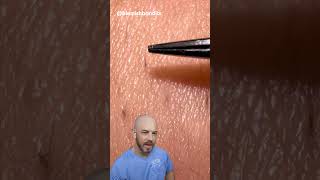 These ingrown hair pulls are super satisfying credit blemishbandits on TT doctor satisfying [upl. by Iain]