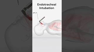 Endotracheal Intubation [upl. by Ayoral]