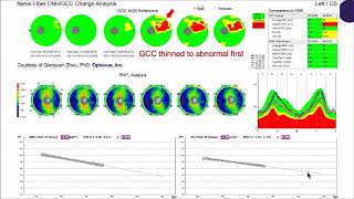 OCT What should I image –NFL ganglion cell or both [upl. by Wilt]