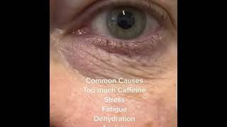 Blepharospasm shortvideoopthalmiceyesoptometristfactsstresscaffiene [upl. by Jesher]