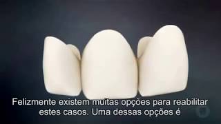 Prótese fixa de 3 elementos em cerâmica sobre dentes [upl. by Ettenuahs411]