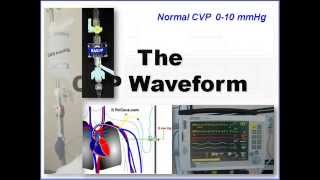 Invasive Monitoring Series Episode 2 Interpreting CVP and Art Lines with Cardiac Dysfunction [upl. by Derwood612]