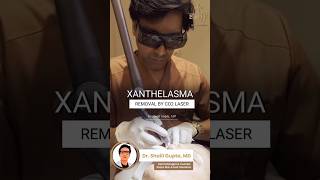 Xanthelasma Removal by CO2 Laser  Fat deposit removal treatment xanthelasma shortvideo skincare [upl. by Bard]