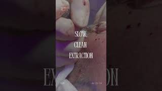 🎥 Slow Clean Extraction by SHIFT Hair in Istanbul 🎥 [upl. by Aihsenrad]