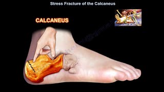 Stress Fracture of the Calcaneus  Everything You Need To Know  Dr Nabil Ebraheim [upl. by Aneetsirk785]