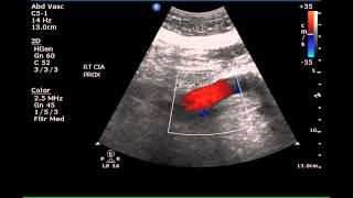 Sonographic Demonstration of Ectasia of the Iliac Arteries  Case Study [upl. by Sunday]