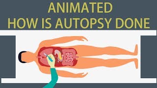 Autopsy Detailed animation on how is Autopsy done [upl. by Stiles139]