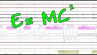 Complex Sleep Apnea and Treatment What is Complex Sleep Apnea Real Sleep Study Shown F [upl. by Ronaele17]