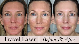 Fraxel Face Laser  Before amp After 3 Month Update [upl. by Osnola]