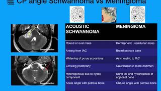 CP Angle tumors Schwannoma Meningioma [upl. by Anidene]