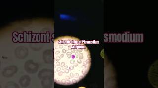 Schizont stage of Plasmodium falciparum  Malarial Parasitology [upl. by Aytnahs]