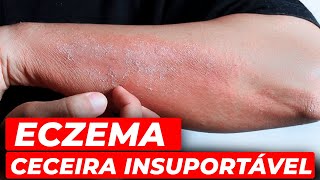 ECZEMA O que é e como aliviar os sintomas [upl. by Huxham]