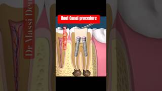 ROOT Canal Procedure on Molar [upl. by Bueschel946]