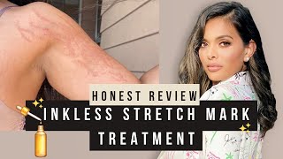 I got the Inkless Stretch Mark Treatment My honest review youtubevideos stretchmarks skincare [upl. by Vevina]