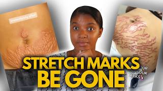 Stretch Mark Tattoos The Power of Paramedical Tattooing [upl. by Nytsirt522]