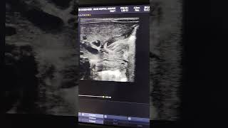 Congenital hypertrophic pyloric stenosis in neonates ultrasoundscans baby [upl. by Ytnom57]