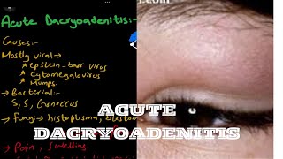 Acute dacryoadenitis  lacrimal system [upl. by Eidnar968]