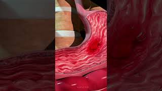 Formation of an Ulcer in the Stomach [upl. by Lekcim]