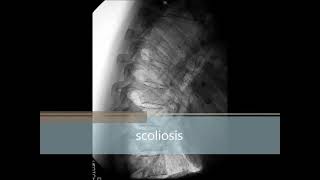 Transforming My Own Scoliosis [upl. by Kaczer]