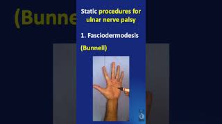 Shorts 59 Part 2  Static procedures for ulnar nerve palsy  procedures and modifications [upl. by Audri]