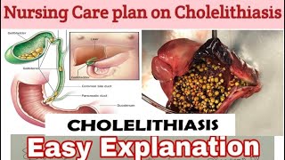 Nursing care plan on Cholelithiasis NCP on CholelithiasisNursing process with nursing diagnosis [upl. by Newol]