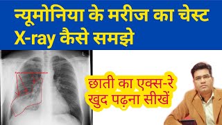 How to Read Chest Pneumonia XRay Findings  फेफड़े का एक्सरे कैसे समझे [upl. by Jt]