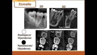 Anatomia radiográfica do dente e periodonto [upl. by Tacita]