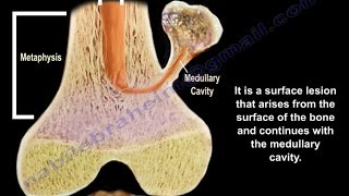 Osteochondroma  solitary and multiple  Everything You Need To Know  Dr Nabil Ebraheim [upl. by Eselahc]