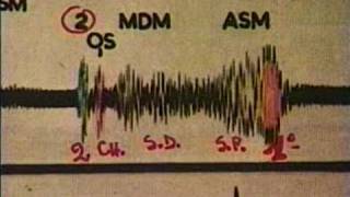 Bases de la Auscultacion Cardiaca II [upl. by Kaule]