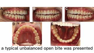 Standard orthodontic treatment after condylectomy for patients with active unilateral condylar hyper [upl. by Grussing996]