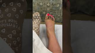 6 weeks of Lisfranc injury ORIF surgery and healing in 24 seconds [upl. by Adnawed340]