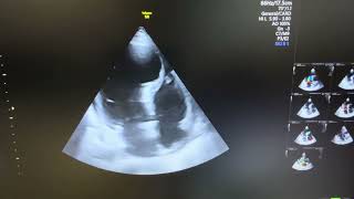 Post MI interventricular septum basal side aneurysm [upl. by Ahsinyar]