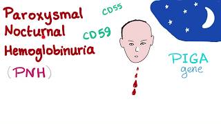 Paroxysmal Nocturnal Hemoglobinuria PNH  Hemolytic Anemia  Complement Alternative Pathway [upl. by Grange]