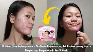 I tried Brilliant Skin Hydroquinone  Tretinoin Rejuvenating Set on my Severe Pimples amp Pimple Marks [upl. by Ahsinid276]