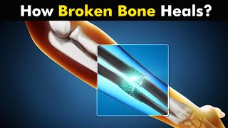 Process of Bone Healing  Bone Healing Steps UrduHindi [upl. by Ayokal]