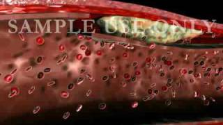 Artery Dissection Medical Animation [upl. by Myrt]