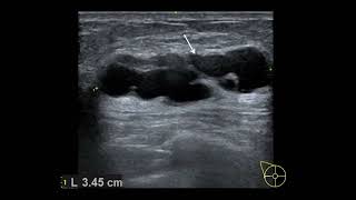 Breast fibrocystic disease 유방 섬유 질환 [upl. by Heimer]