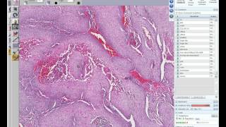 Medical School Pathology 2012 Session 014 Neoplasm Lab IImp4 [upl. by Emmalyn]