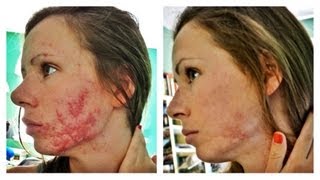 How We Got Rid of Our Acne  Accutane Isotretinoin Experience [upl. by Guod]