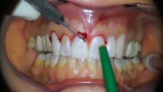 Gingivectomy  Procedure to eliminate suprabony pockets  Dental Clinic [upl. by Rumpf41]